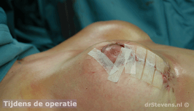 borstlift prothese 180cc vrouw - drstevens.nl