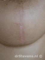 borstlift prothese 300cc vrouw - drstevens.nl