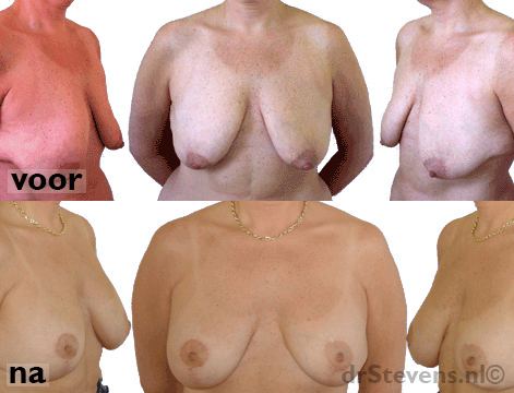 borstlift prothese 325cc vrouw - drstevens.nl