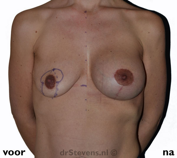 borstlift prothese a-cup vrouw - drstevens.nl
