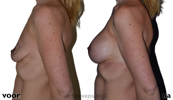 borstlift prothese a-cup vrouw - drstevens.nl