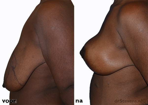 borstlift vrouw - drstevens.nl