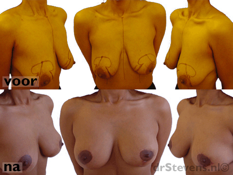 borstvergroting liposuctie asymmetries vrouw - drstevens.nl