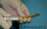 liposuctie bloedvaatjes vetcellen operatietechniek - drstevens.nl