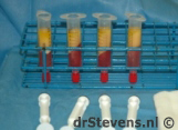 liposuctie vetcellen operatietechniek - drstevens.nl