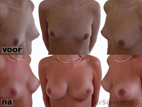borstvergroting asymmetries natuurlijk vrouw - drstevens.nl