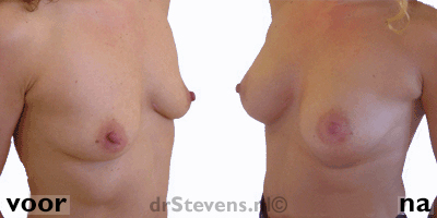 borstvergroting vrouw - drstevens.nl