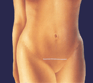 illustratie operatietechniek liposuctie buikwandcorrectie - drstevens.nl