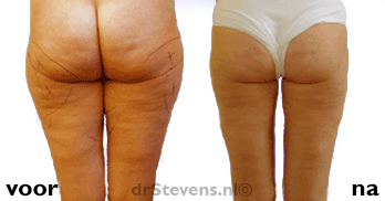 bovenbenen-achterzijde 3100cc liposuctie vrouw - drstevens.nl