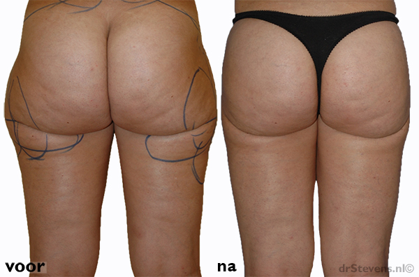 bovenbenen-achterzijde liposuctie vrouw - drstevens.nl