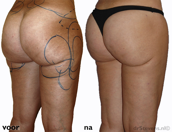 bovenbenen-achterzijde liposuctie vrouw - drstevens.nl