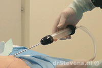 liposuctie operatietechniek weg-zuigen bovenbenen - drstevens.nl