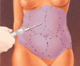 illustratie techniek correctie canules sneetjes-maagbuikflank liposuctie - drstevens.nl