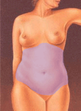 illustratie techniek correctie maagbuikflank liposuctie - drstevens.nl