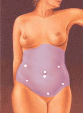 illustratie techniek correctie steekgaatjes maagbuikflank liposuctie - drstevens.nl