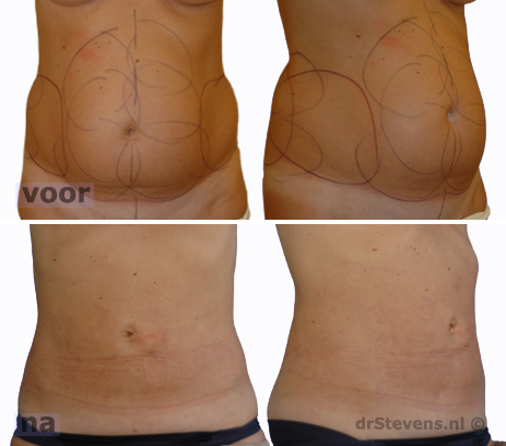 liposuctie maag buik taille rug vrouw - drstevens.nl