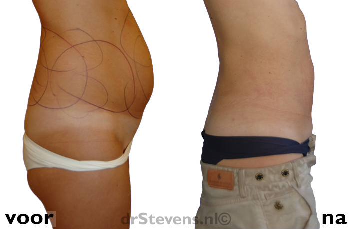 liposuctie maag buik taille rug vrouw - drstevens.nl