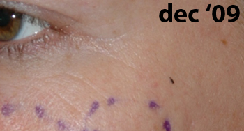 bio-chirurgie kraaienpootjes vrouw - drstevens.nl