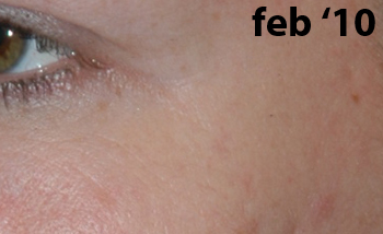 bio-chirurgie kraaienpootjes vrouw - drstevens.nl