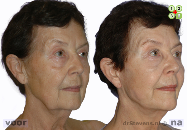 facelift groeifactoren aangezicht vrouw - drstevens.nl