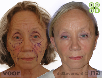 hals-facelift lipofilling aangezicht vrouw - drstevens.nl