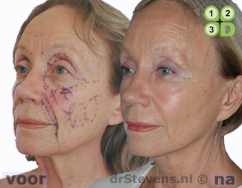 hals-facelift lipofilling aangezicht vrouw - drstevens.nl