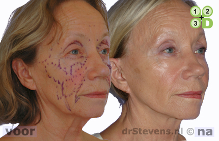 hals-facelift lipofilling aangezicht vrouw - drstevens.nl