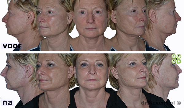 hals-facelift lipofilling aangezicht vrouw - drstevens.nl