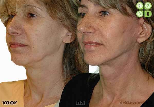 hals-facelift lipofilling kaaklijn aangezicht vrouw - drstevens.nl