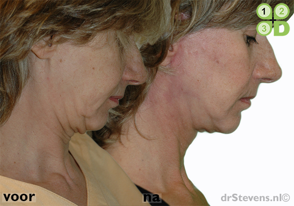 hals-facelift lipofilling kaaklijn aangezicht vrouw - drstevens.nl