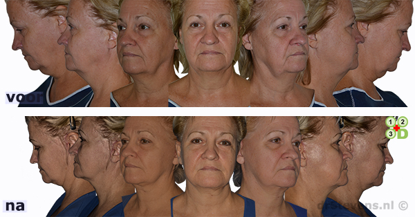 hals-facelift lipofilling rouwplooien aangezicht vrouw - drstevens.nl