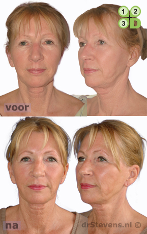 hals-facelift lipofilling wangen aangezicht vrouw - drstevens.nl