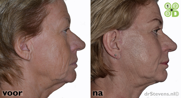 hals-facelift ooglidcorrectie lipofilling groeifactoren aangezicht vrouw - drstevens.nl