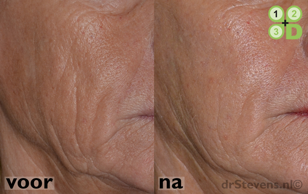 hals-facelift ooglidcorrectie lipofilling groeifactoren aangezicht vrouw - drstevens.nl