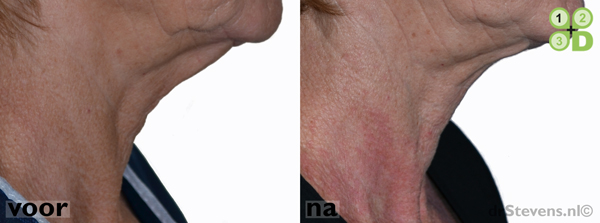 hals-facelift ooglidcorrectie lipofilling groeifactoren aangezicht vrouw - drstevens.nl