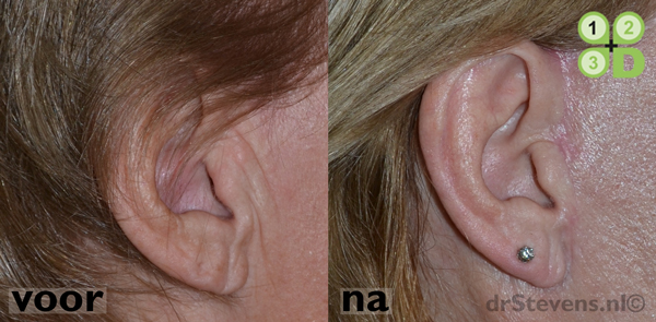 hals-facelift ooglidcorrectie lipofilling groeifactoren aangezicht vrouw - drstevens.nl