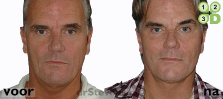 hals-facelift trend-watching aangezicht man - drstevens.nl