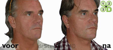 hals-facelift trend-watching aangezicht man - drstevens.nl