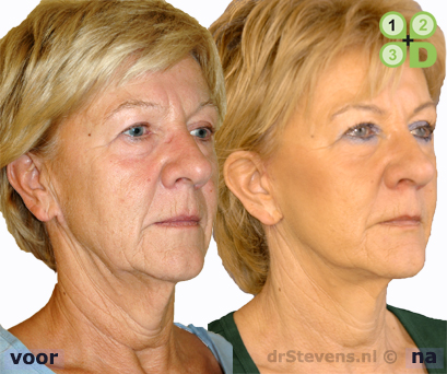 halslift aangezicht vrouw - drstevens.nl