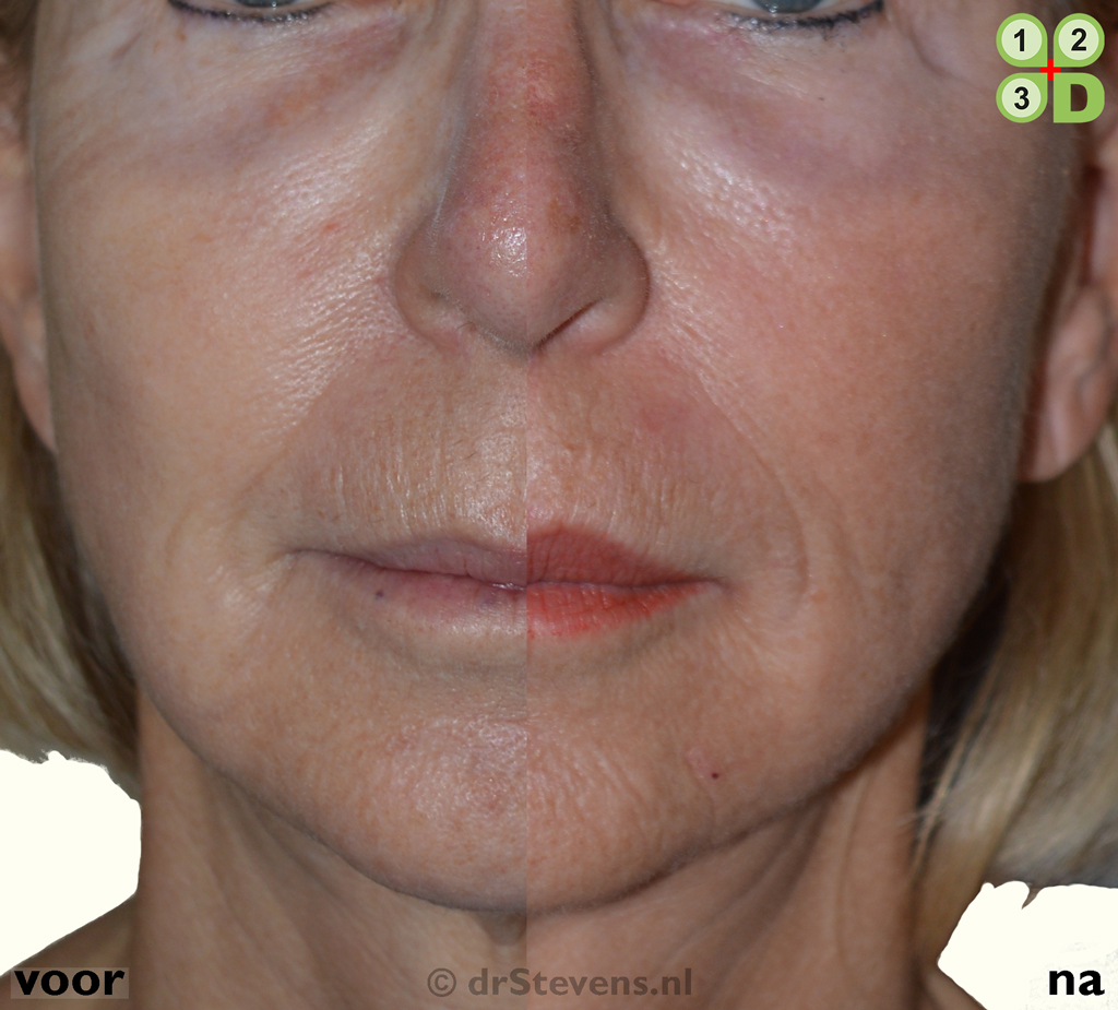 lipofilling, groeifactoren, tarsal tuck en een liplift - drStevens.nl