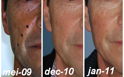 lipofilling aangezicht man - drstevens.nl