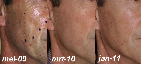 lipofilling aangezicht man - drstevens.nl
