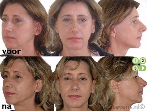 lipofilling aangezicht vrouw- drstevens.nl