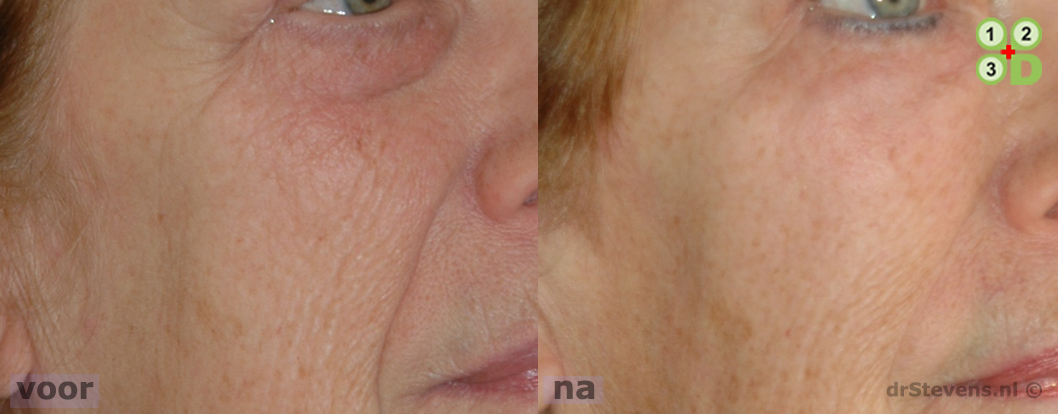 macs-lift bio-chirurgie wang aangezicht vrouw - drstevens.nl