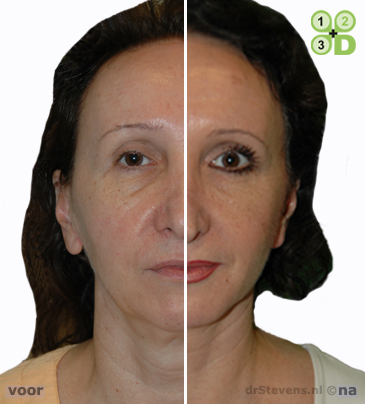 macs-lift lipofilling aangezicht vrouw - drstevens.nl
