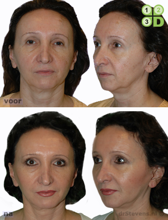 macs-lift lipofilling aangezicht vrouw - drstevens.nl