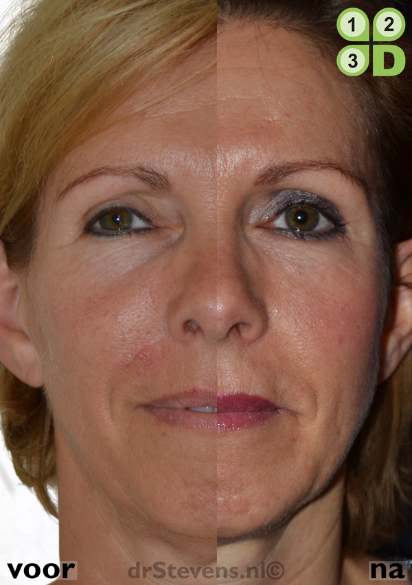 macs-lift onderooglidcorrectie lipofilling aangezicht vrouw - drstevens.nl