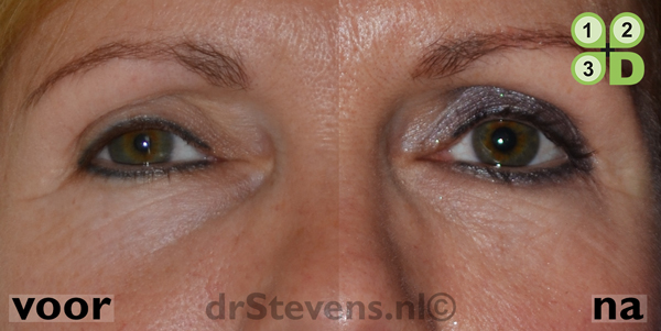 macs-lift onderooglidcorrectie lipofilling aangezicht vrouw - drstevens.nl
