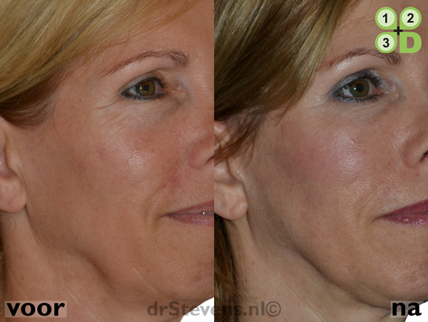 macs-lift onderooglidcorrectie lipofilling aangezicht vrouw - drstevens.nl