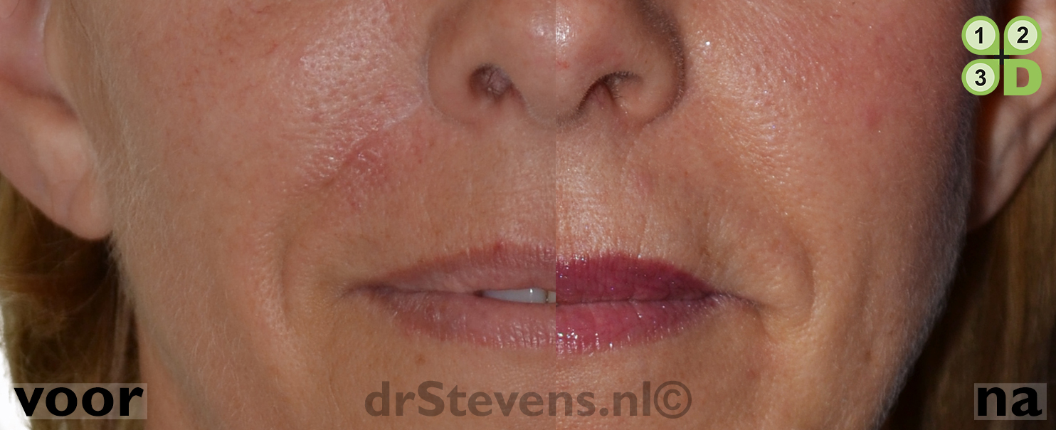 macs-lift onderooglidcorrectie lipofilling aangezicht vrouw - drstevens.nl